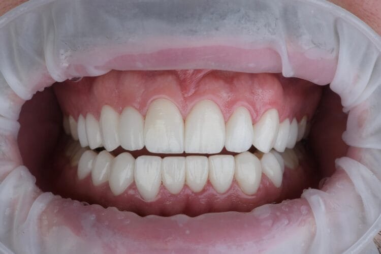 lamine veneer ankara