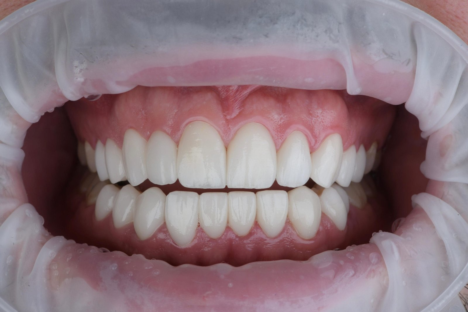 laminated veneer ankara