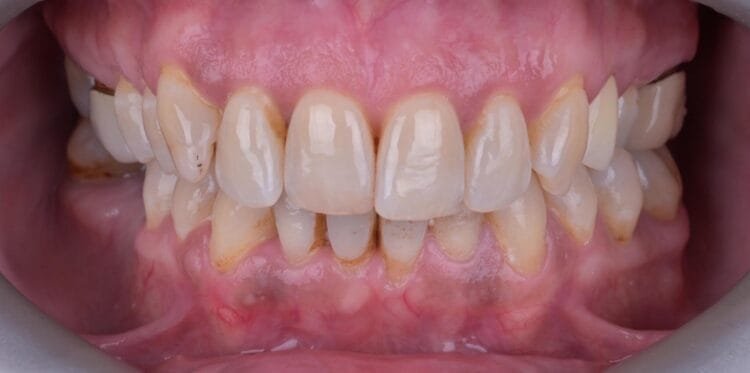 implants and smile design