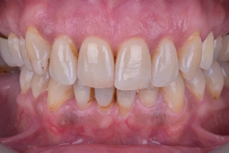 implant ve gülüş tasarımı