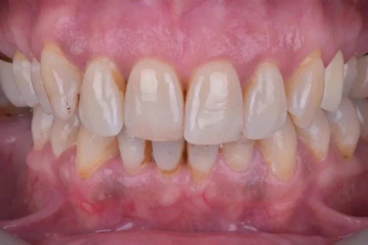 implant ve gülüş tasarımı