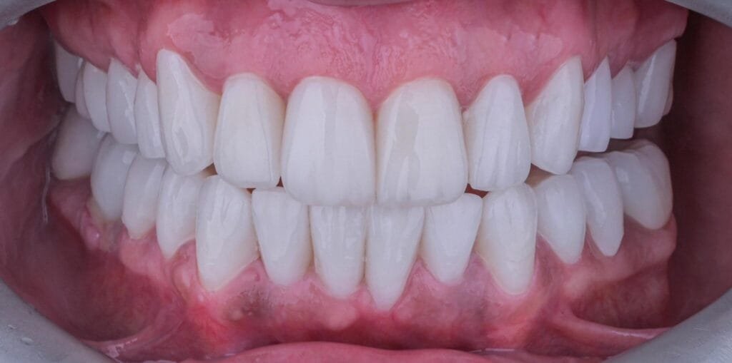 gummy smile ankara