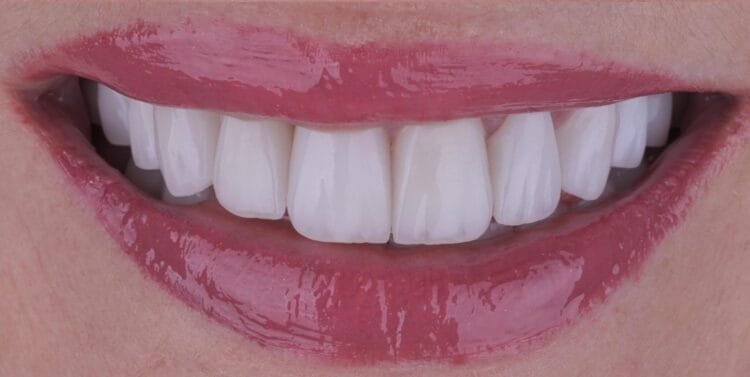 zirconium or veneer