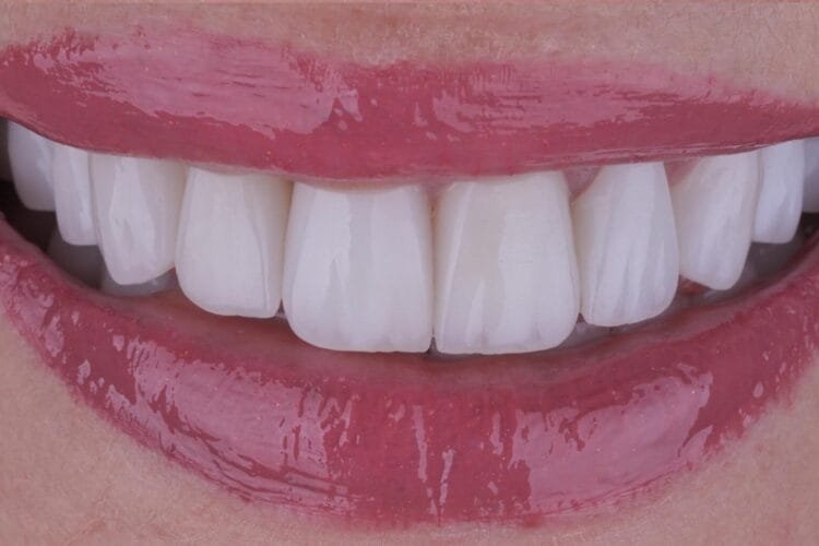 zirkonyum mu veneer mi