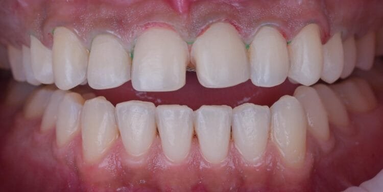 transparent plaque ankara