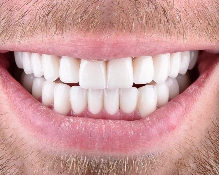 teeth whitening ankara